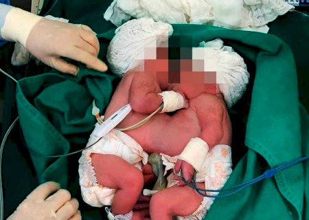 Jovem dá à luz gêmeas siamesas em maternidade de Salvador