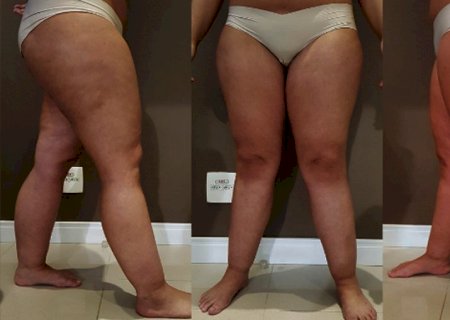Lipedema, a doença que causa dor, inchaço e ocorre principalmente em mulheres