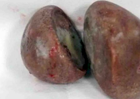 Médicos retiram duas pedras gigantes de dentro da vagina de mulher na Indonésia