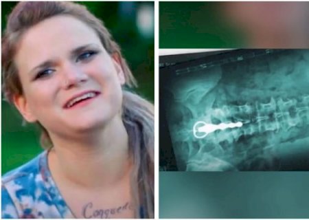 Mulher passa por cirurgia após ficar com vibrador preso no reto: ‘sentia vibrar nas minhas costas’