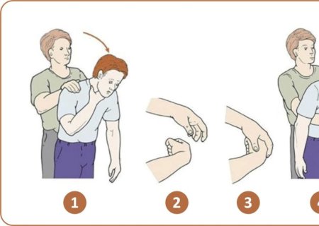 Aprenda a fazer a Manobra de Heimlich, que pode ajudar quem está engasgado